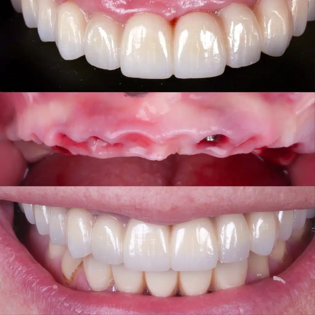 Foto de caso de colocación prótesis fija sobre implantes en el mismo día