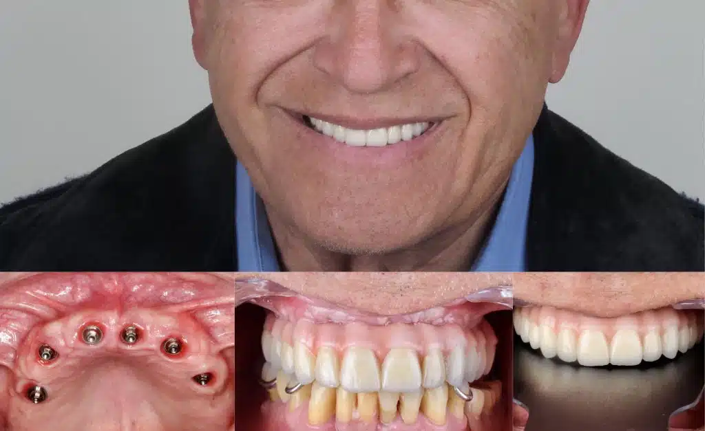Opinión prótesis fija sobre implantes dentales