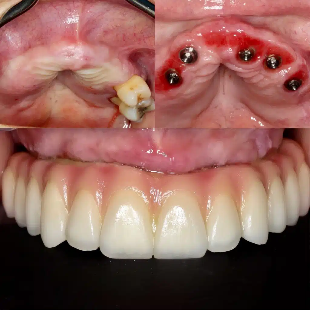 Foto caso antes y después dentadura fija sobre implantes dentales