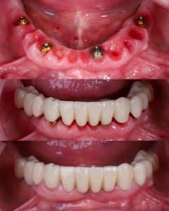 prótesis fija sobre 4 implantes all on 4