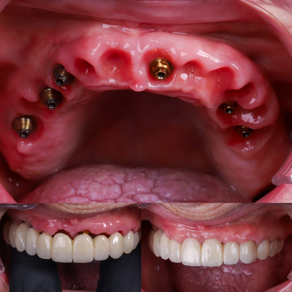 foto de implantes en toda la boca en el mismo dia con implantes de carga inmediata