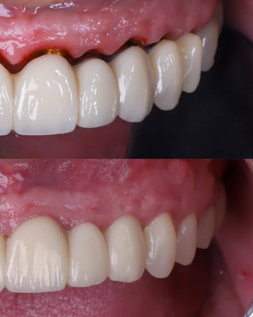 implantes dentales toda la boca respetando y regenerando la encía