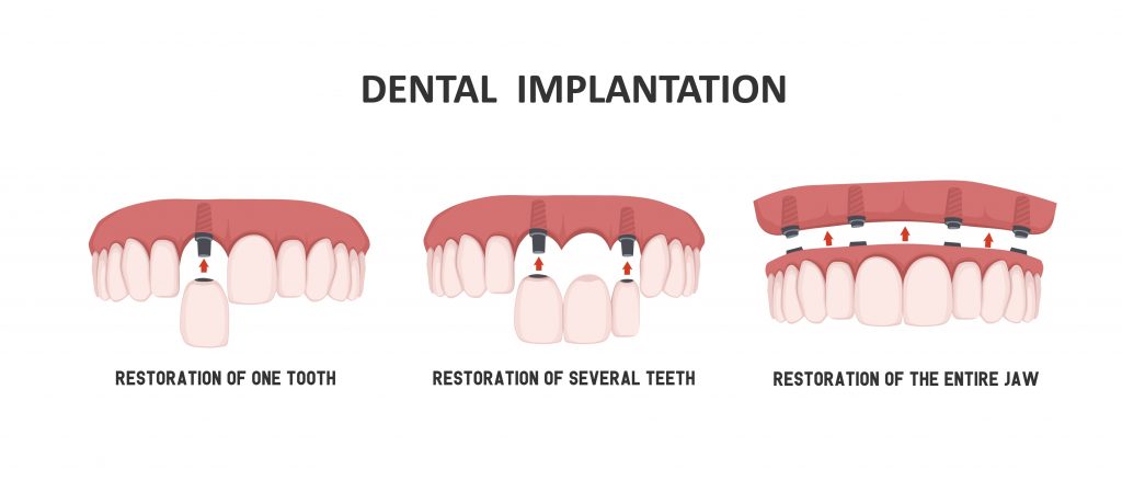 foto tipos de implantes carga inmediata