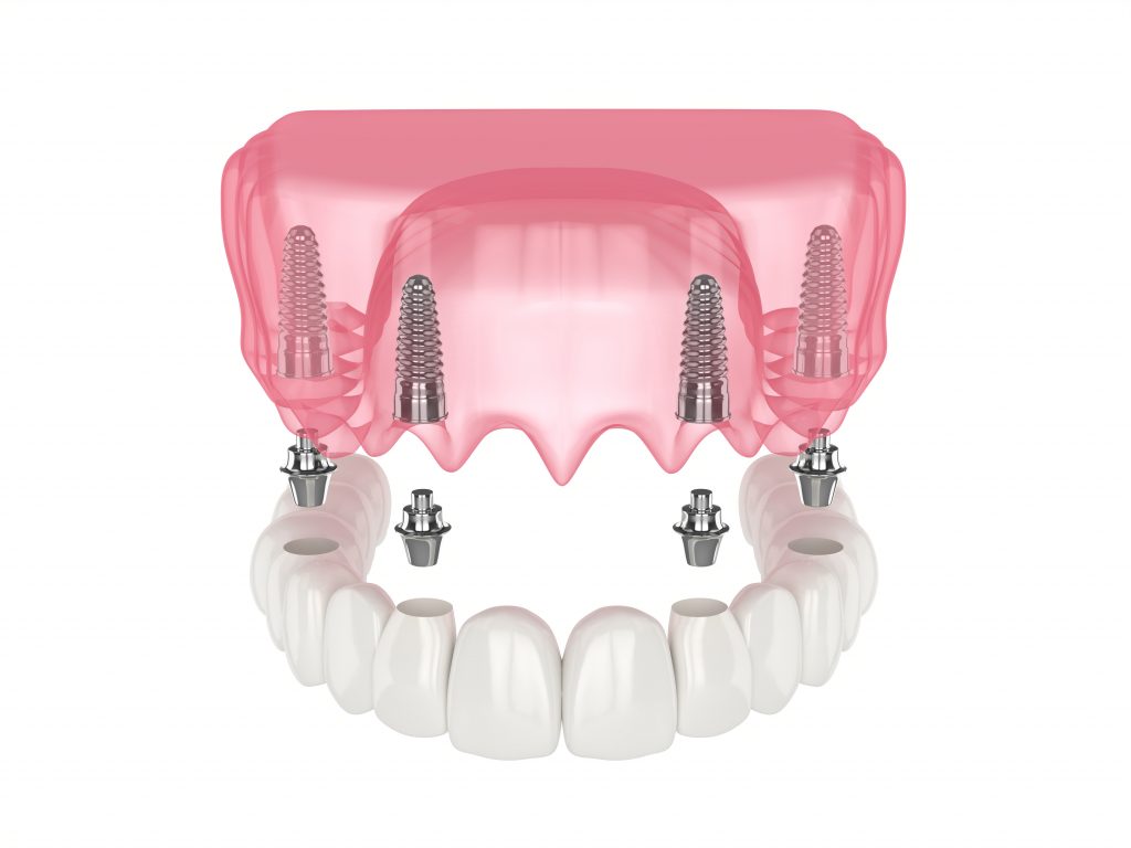 foto de prótesis fija sobre 4 implantes dentales para toda la boca mediante carga inmediata