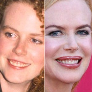 foto antes y despues sonrisa gingival Nicole Kidman