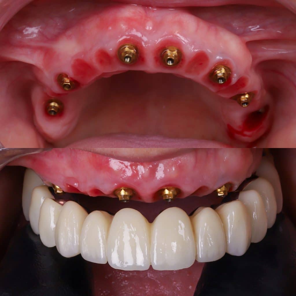 foto de implante completo para prótesis fija sobre 4 implantes