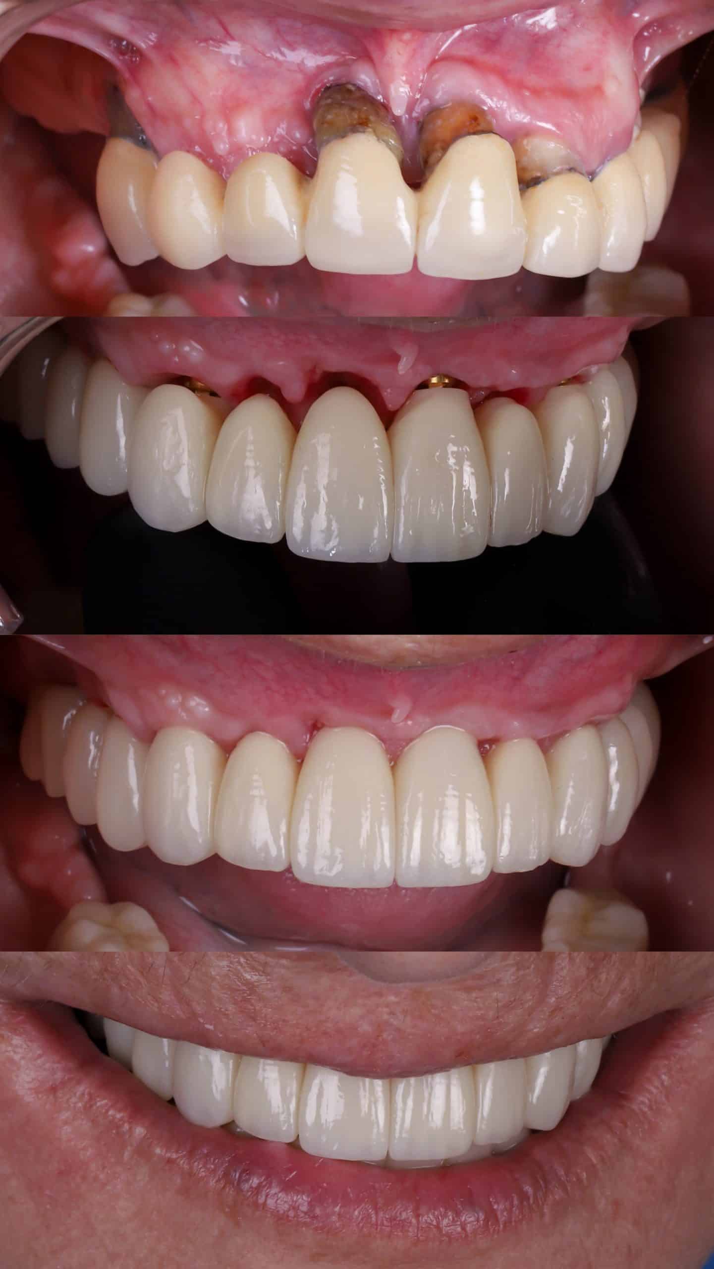 caso antes y después de regeneración ósea para implantes dentales