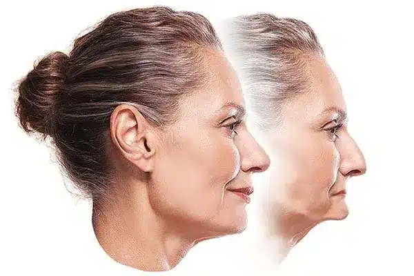 foto estética facial antes y después de perder hueso alveolar