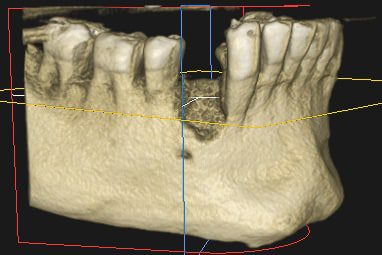 regeneración hueso para implante dental