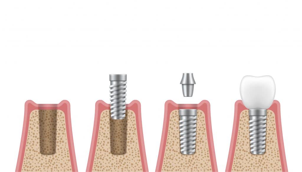 proceso integración implante dental y Alimentación con implantes dentales
