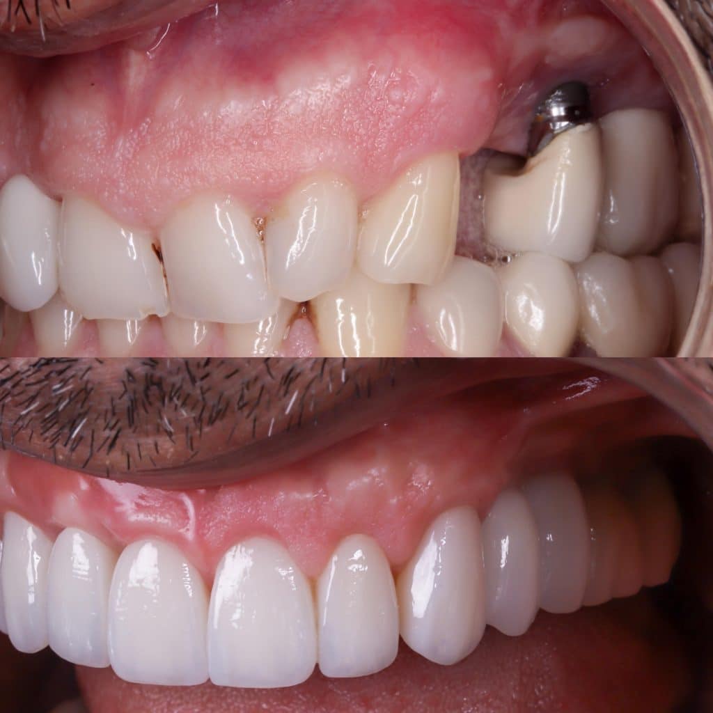 rechazo implante dental después de años