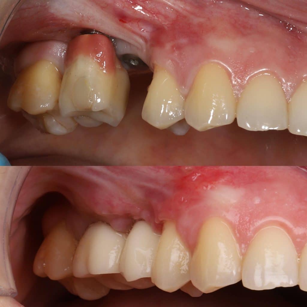 Síntomas rechazo implante dental