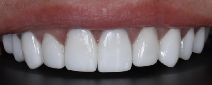 carillas de composite