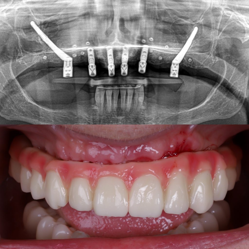 implantes cigomáticos para pacientes sin hueso dental