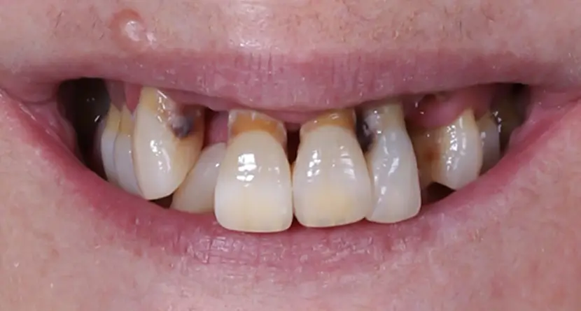 Implantes dentales post-cirugía y prótesis final con encías sanas.