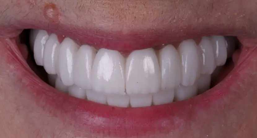 implantes boca completa antes y después