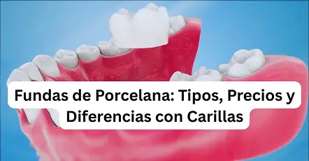 Diagrama de corona dental de porcelana