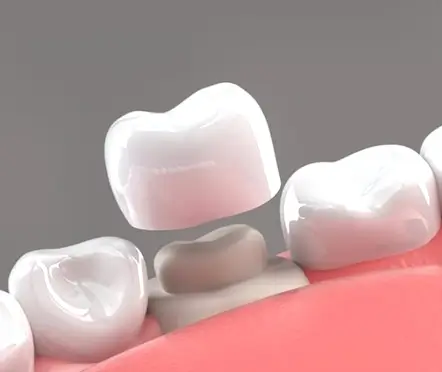 Colocación de corona dental en el diente