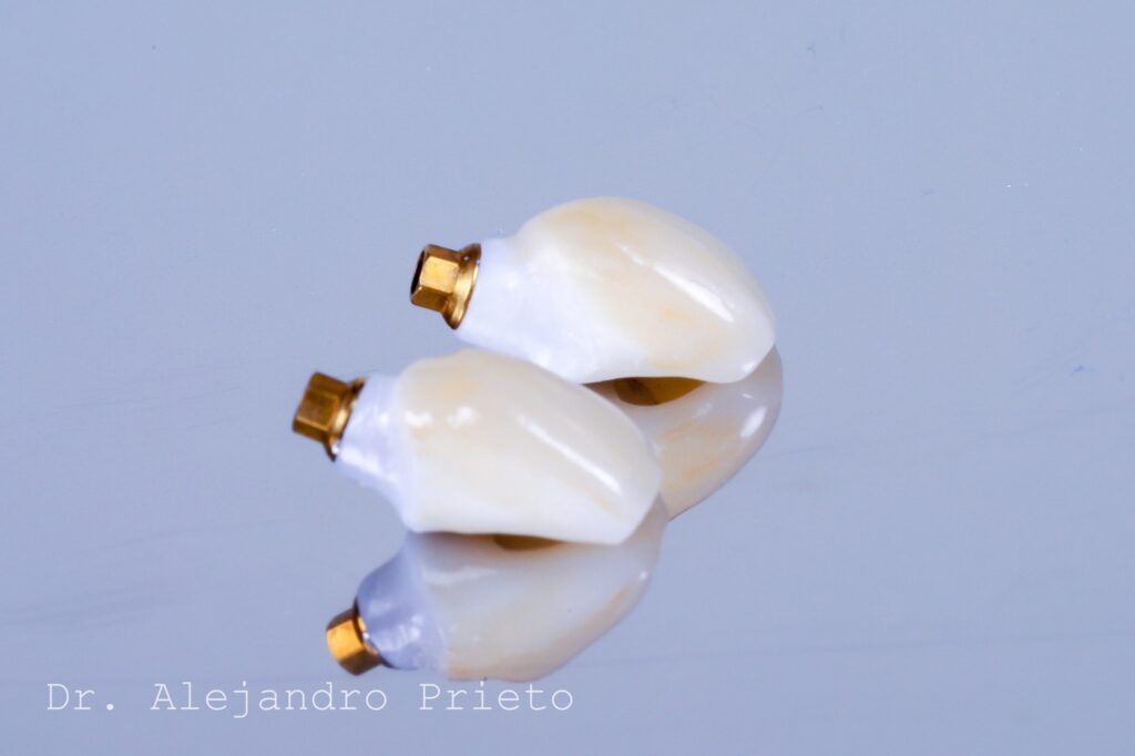 Coronas dentales de zirconia con base metálica dorada.