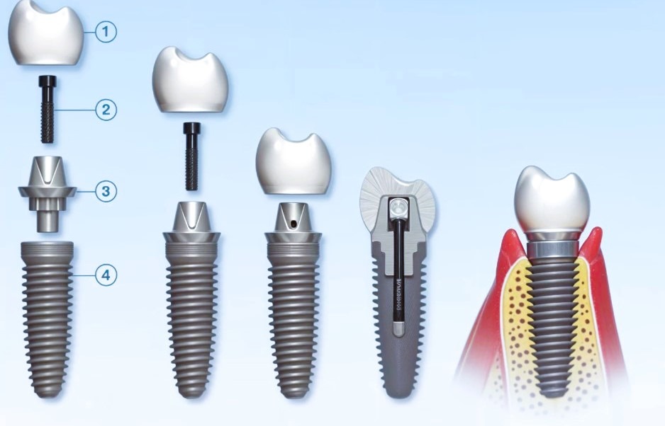 Restauración dental con implantes: proceso y resultado.