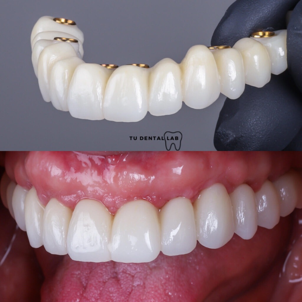 Puente dental sobre implantes: estética y funcionalidad natural.