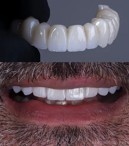 dentadura fija sobre implantes dentales