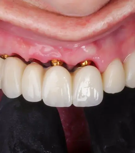 implantes dentales carga inmediata en 24 horas