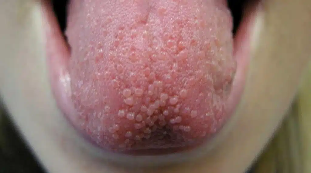 Lengua con úlcera roja e inflamada en la superficie