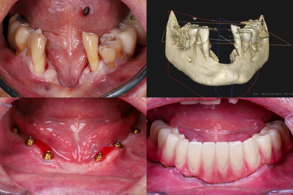 implantes dentales sin hueso