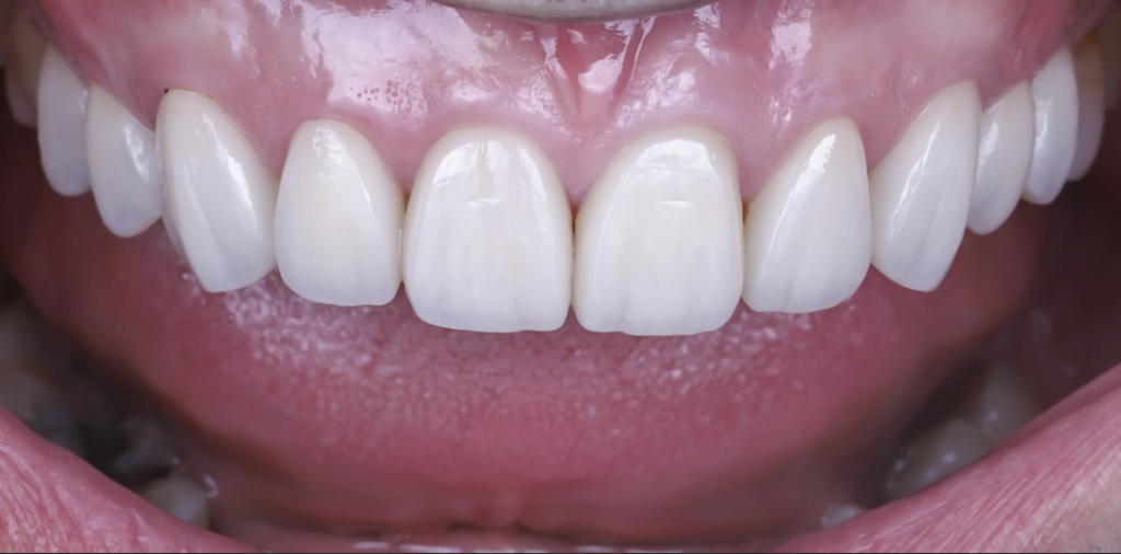 carillas dentales de porcelana en madrid