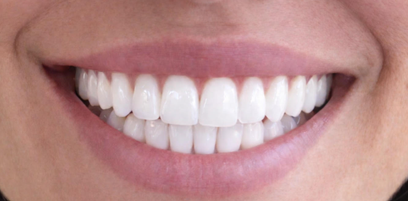 blanqueamiento dental en madrid