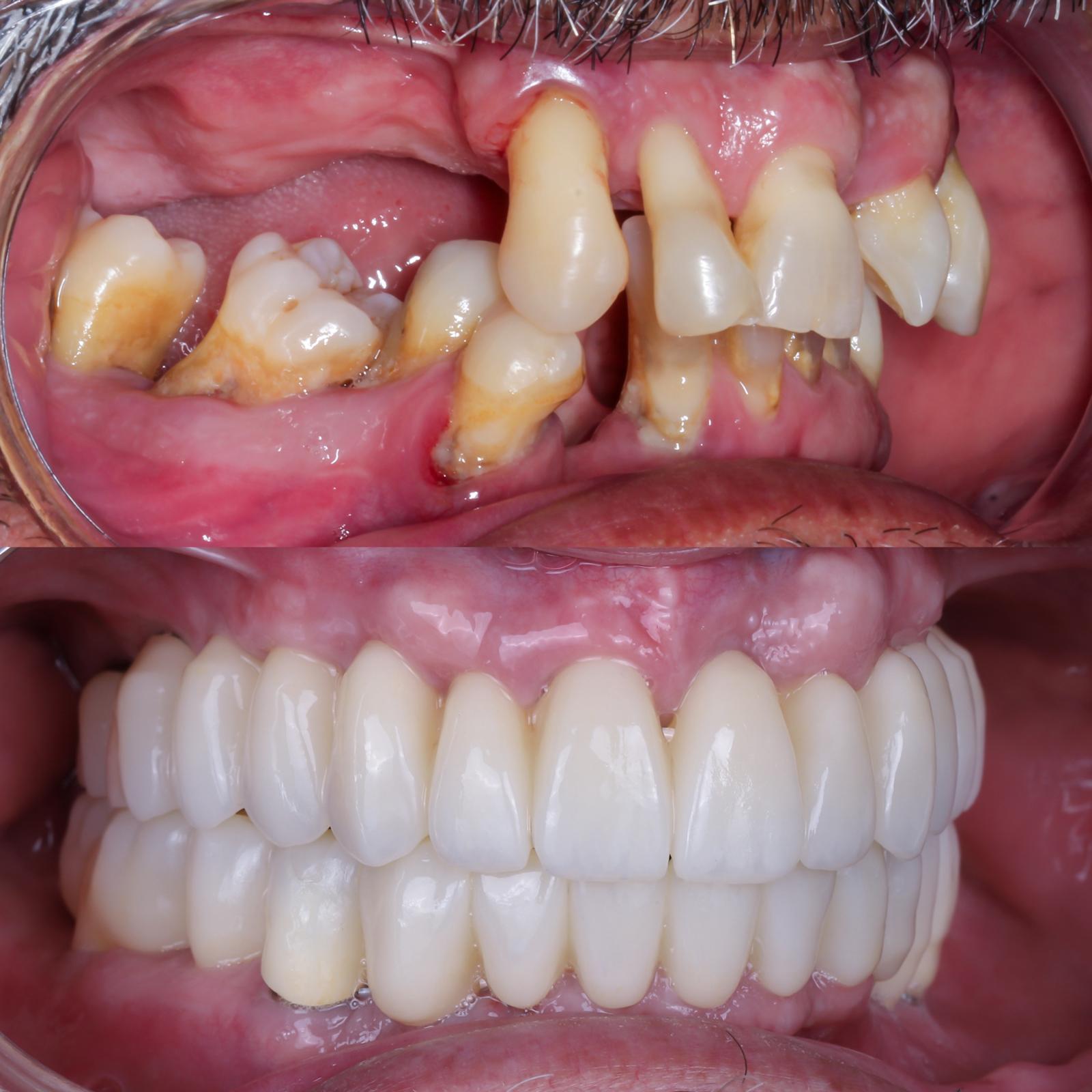 implantes subperiósticos para pacientes sin hueso