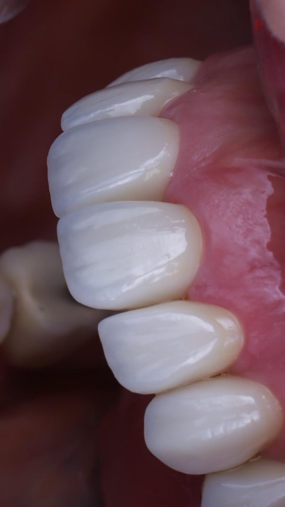 carillas sin tallado en madrid