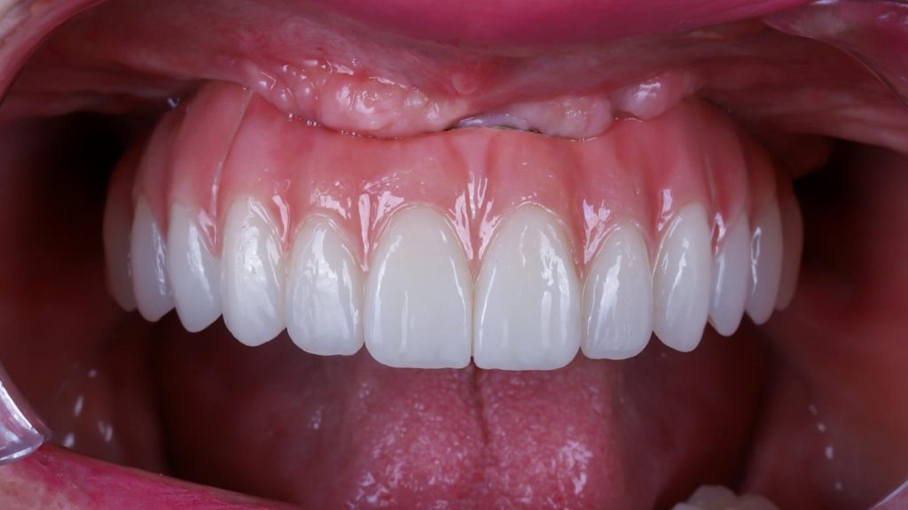 implantes transnasales fotos caso real