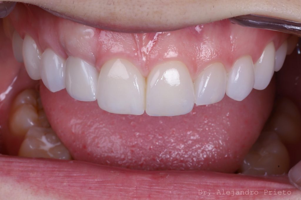 carillas dentales sin tallado