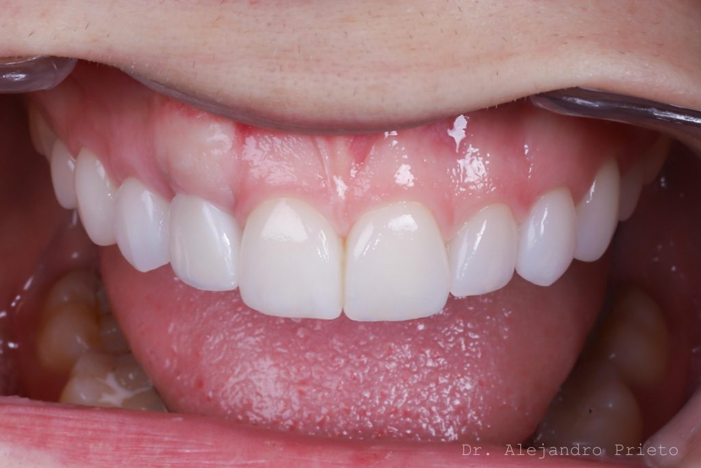 carillas de porcelana madrid