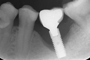radiografia de implante fallido