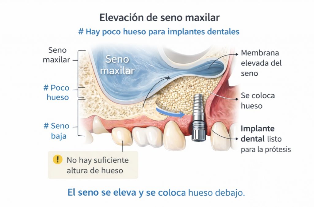 Elevación de seno maxilar y regeneración ósea para implantes dentales