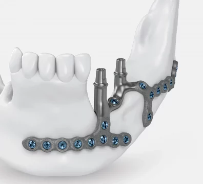 implante-dental-subperiosticos-3d