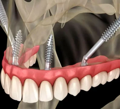 Implantes-pterigoideos