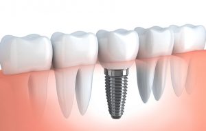 Implantes dentales