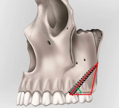 implantes-pterigoideos