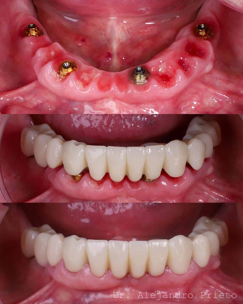foto de implantes dentales