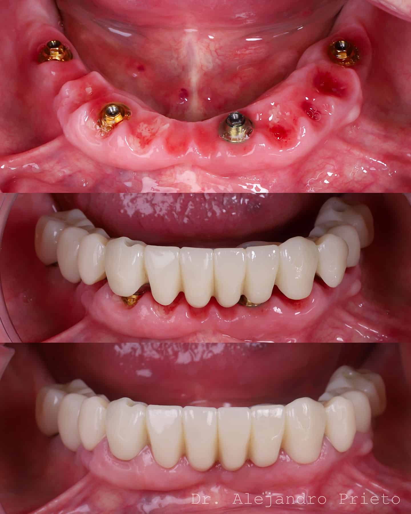 foto de implantes dentales