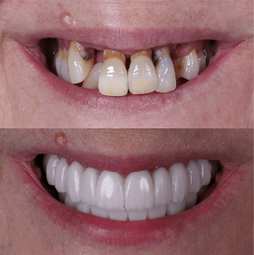 Transformación de sonrisa: Antes y después de implantes dentales de carga inmediata en Madrid