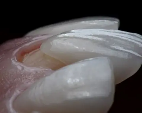 Lámina de carilla de porcelana super macro