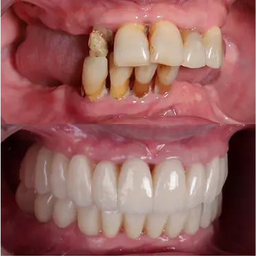 Transformación de sonrisa con tratamiento de estética dental en Barrio Salamanca