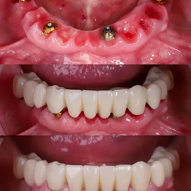 Caso clínico antes y después implantes dentales carga inmediata Madrid