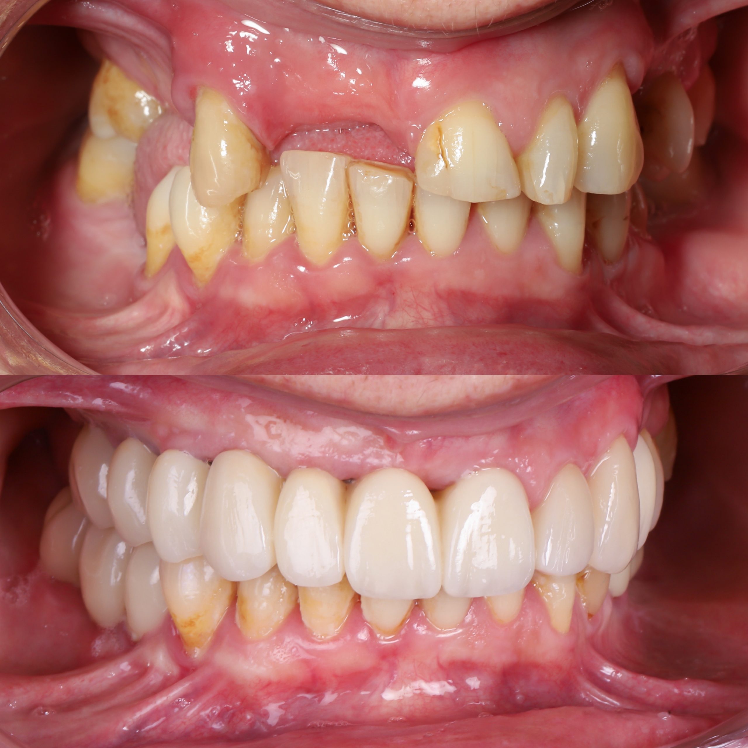 Comparativa antes y después de cirugía de implantes dentales y estética