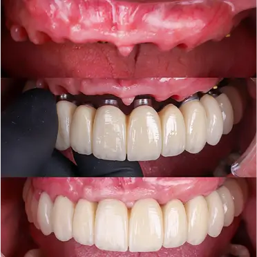 Caso clínico de rehabilitación oral completa sobre implantes y estética